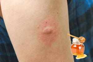 Mẹo trị vết muỗi đốt với mật ong