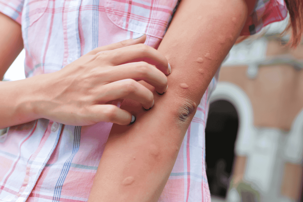 Tại sao có người không bị muỗi đốt?